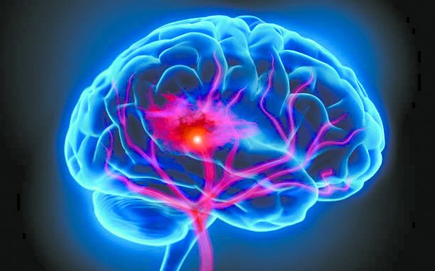 Illustration of human brain with stroke symptom