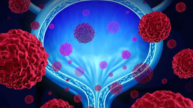 bladdercancer